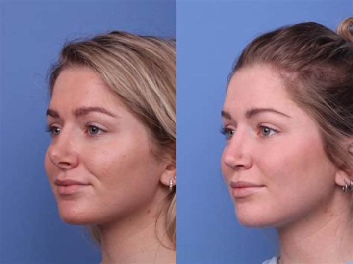 Brie Larson Nose Job and Plastic Surgery Procedures