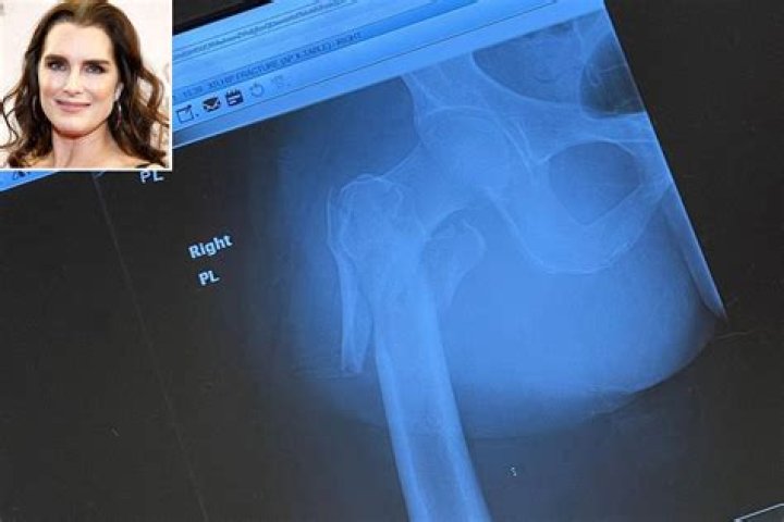 Brooke Shields broke her femur and had to relearn how to walk