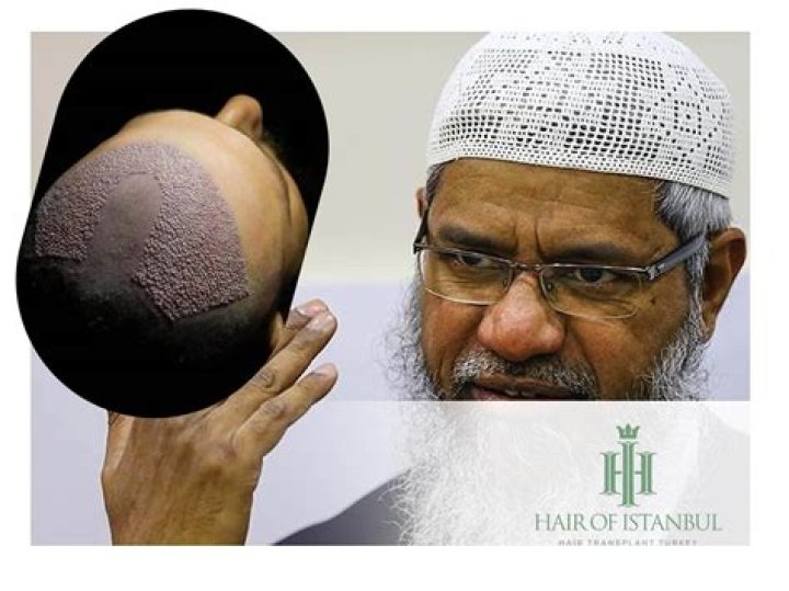 Devout Muslim Luke Shaw Hair Transplant And Tattoos