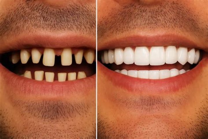 Did Emily Atack Get New Teeth? English Actress’ New Look Explored