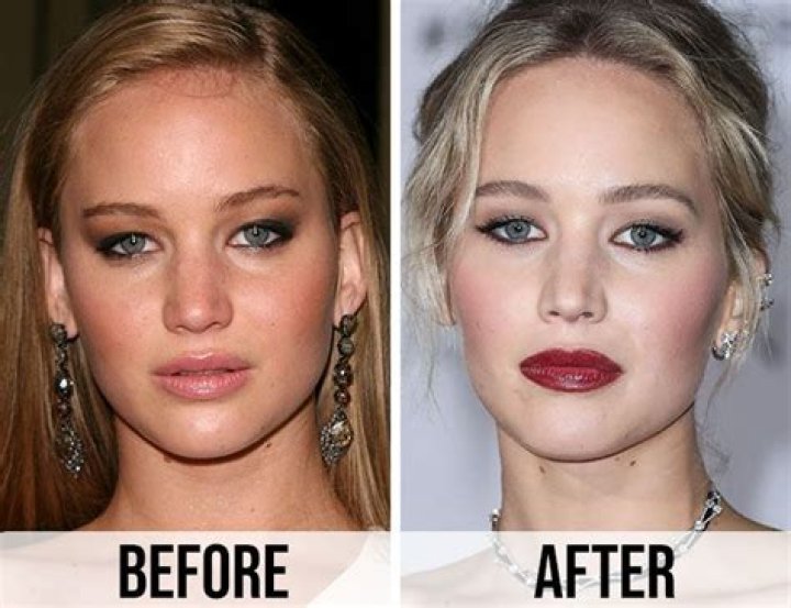 Did Jennifer Lawrence undergo cosmetic surgery? Did Jennifer Lawrence undergo cosmetic surgery?