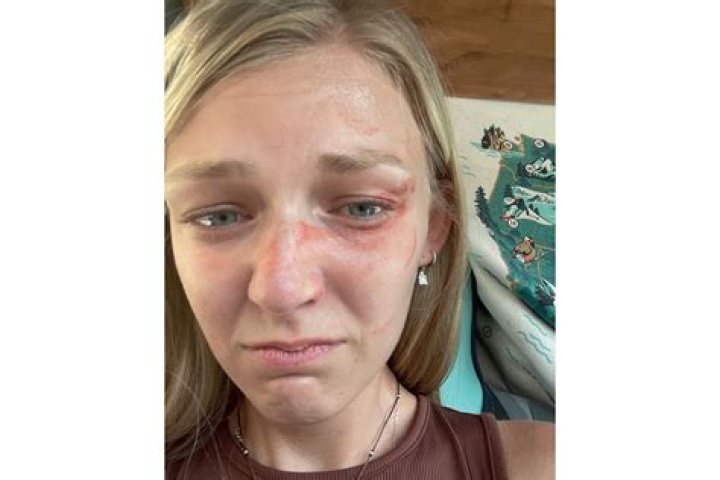 
Gabby Petito Injury Photos Show the Reality of Utah Domestic Abuse 