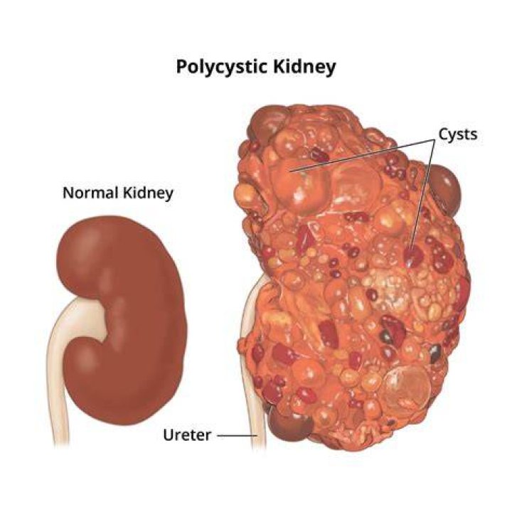 Is hummus bad for kidneys?