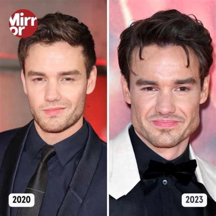 Liam Payne Before And After Looks: The One Direction Singer’s Facial Transformation Seems To Be Insane