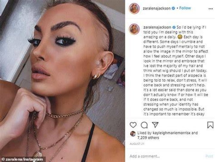 
Model Zaralena Jackson Alopecia Battle: Everything To Know About “Ex On The Beach” Alum 