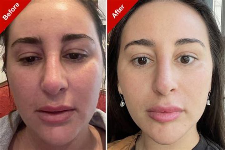 Rachel Bloom Surgery: Before And After Photos, She Is Married To Husband Dan Gregor
