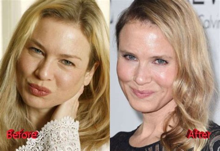 
Renee Zellweger Before And After Plastic Surgery Pictures 