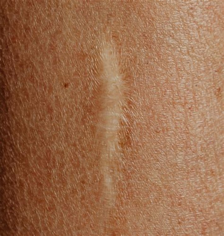 Scar Illnes: What Disease Does Scar Have?
