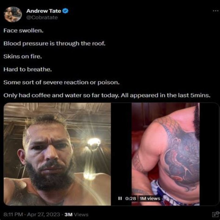 
“Skins on fire”: Andrew Tate concerned with being poisoned, shares images of swollen face on Twitter 
