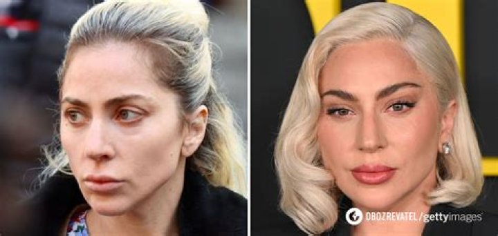 Star: Lady Gaga overdid the Botox & fillers on her nose, lips & forehead