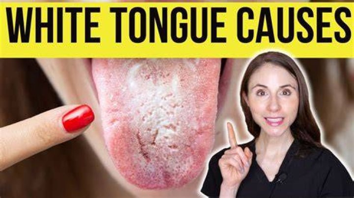 What causes tongue to have teeth marks?