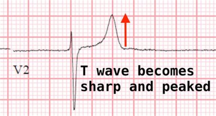 What do peaked T waves represent on an ECG?